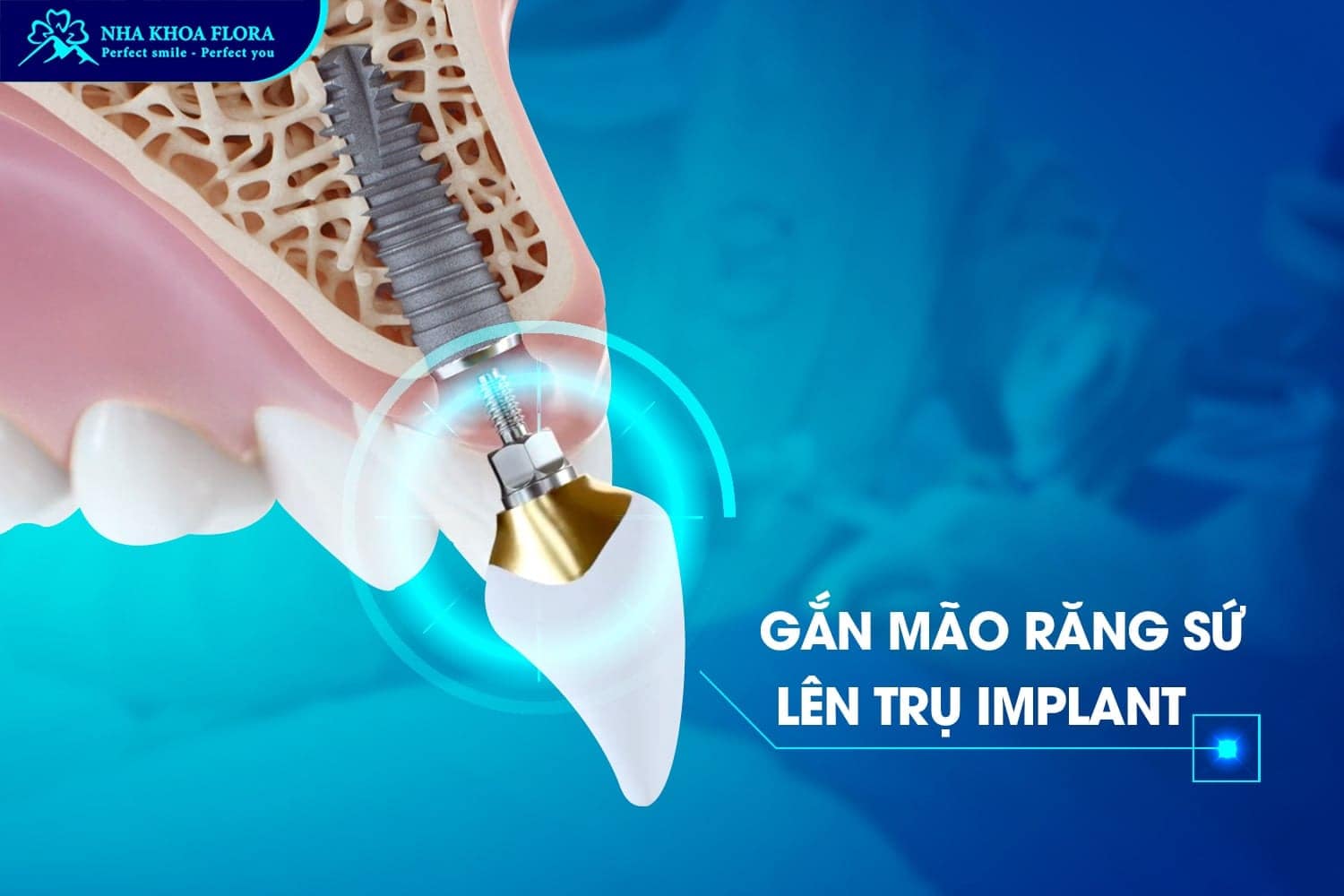 Quy Trình Trồng Răng Implant Chuẩn Quốc Tế - ảnh 3
