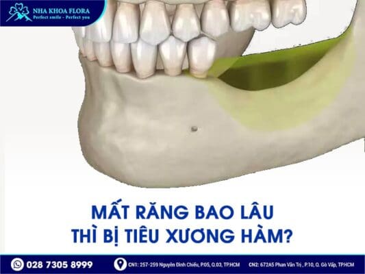 mất răng bao lâu thì bị tiêu xương hàm - ảnh 2