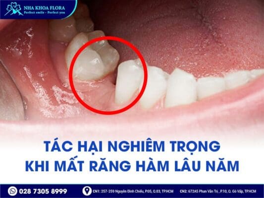 mất răng hàm lâu năm - ảnh 2
