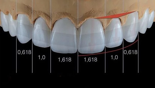 P2 - PERFECT FORM - Thiết kế form răng hài hoà, khít sát