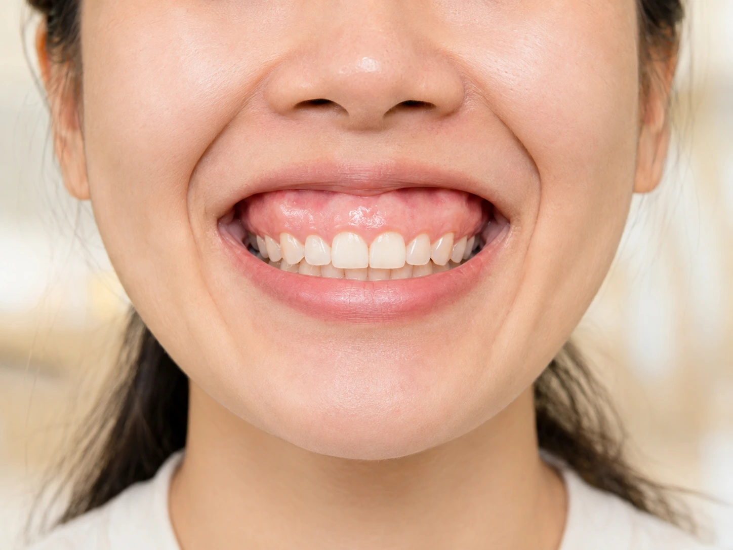 Nụ cười lộ lợi do xương hàm trên phát triển