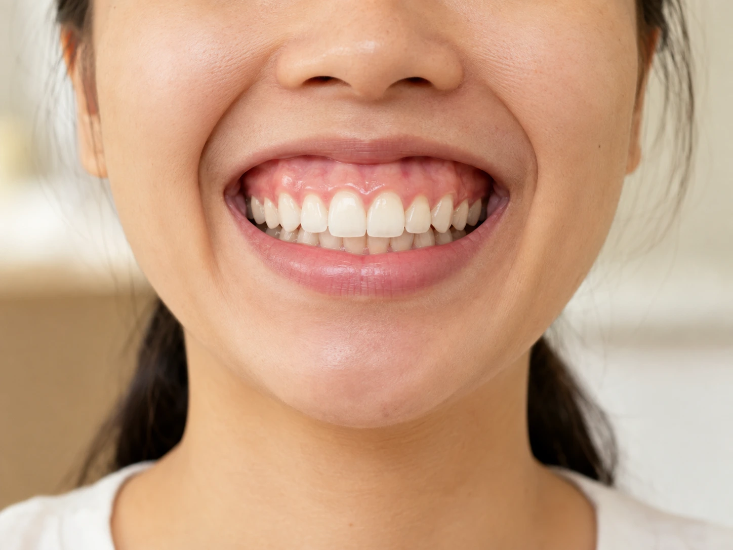 Cười hở lợi do nâng môi trên