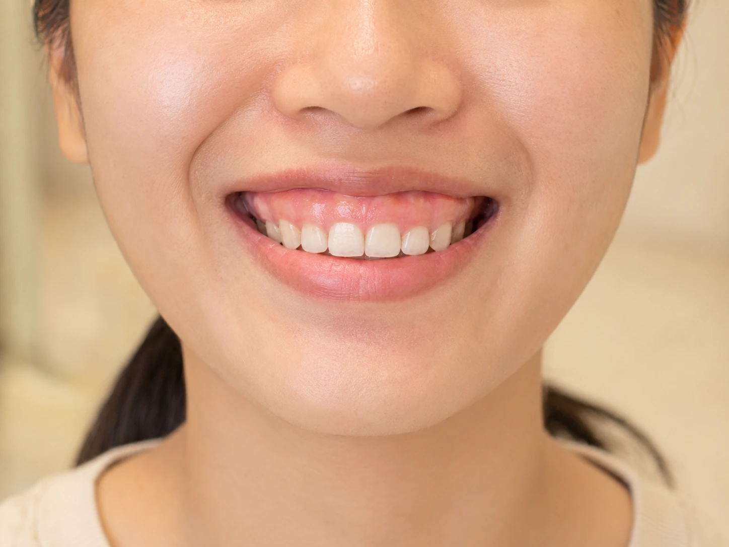 Cười hở lợi do nướu (răng ngắn)