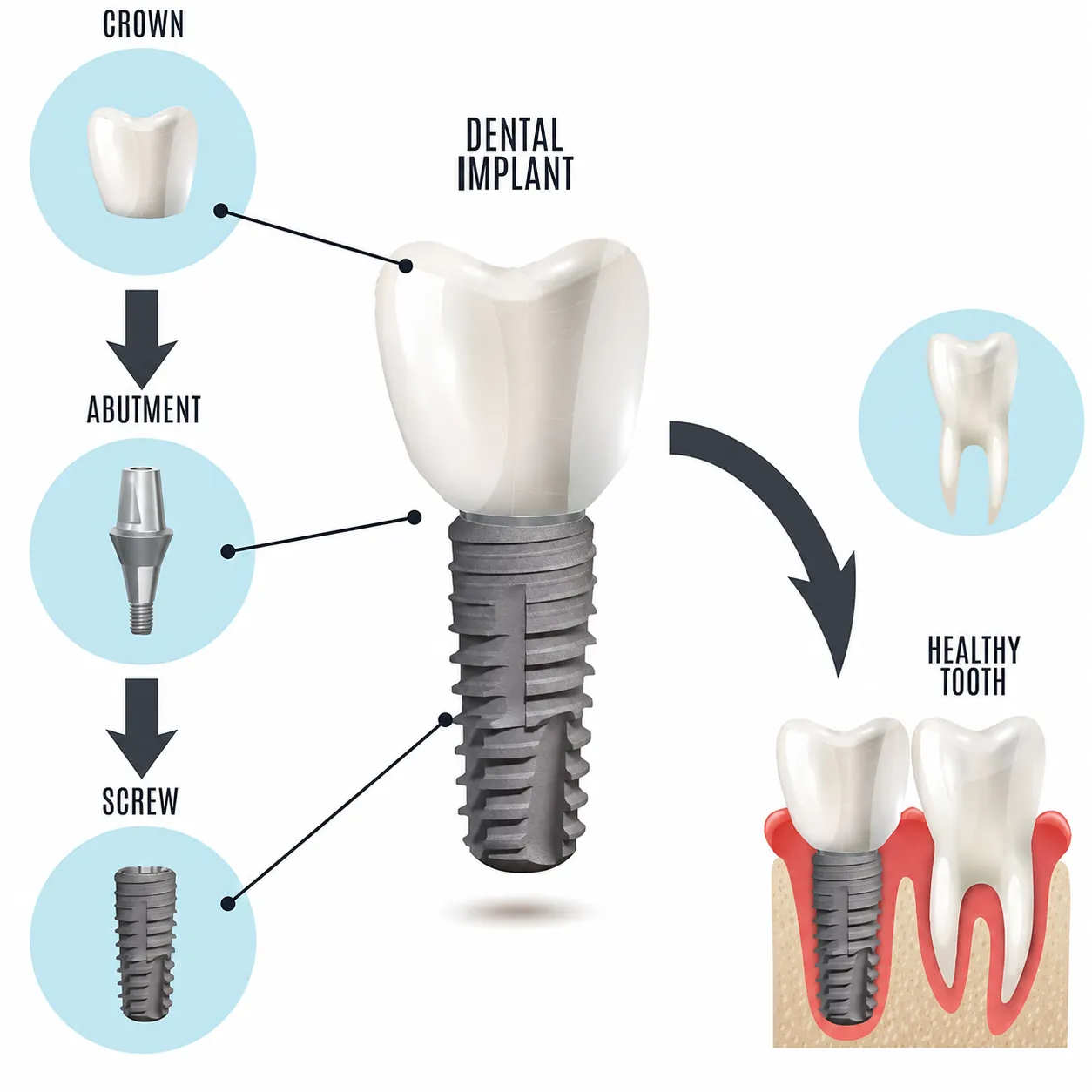 Cấu tạo của một răng trồng Implant