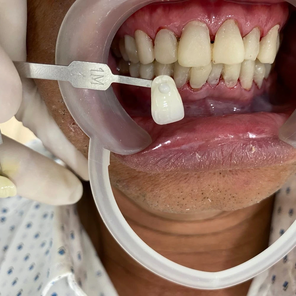 Chú Phan Bá Lương Trước Khi Bọc Răng Sứ
