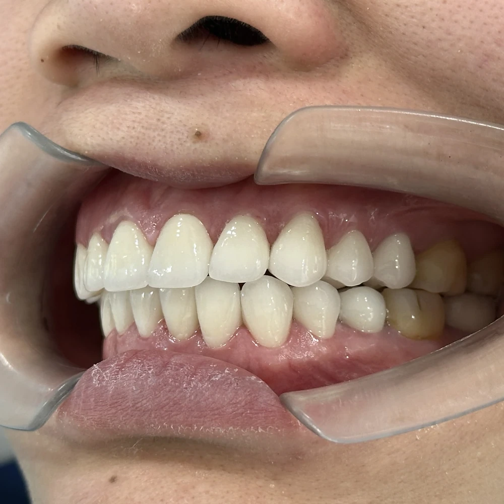 Chị Mai Lê Hồng Diễm Sau Khi Bọc Răng Sứ