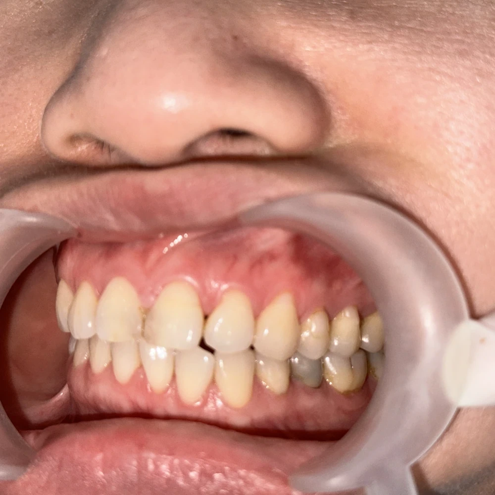 Chị Mai Lê Hồng Diễm Trước Khi Bọc Răng Sứ