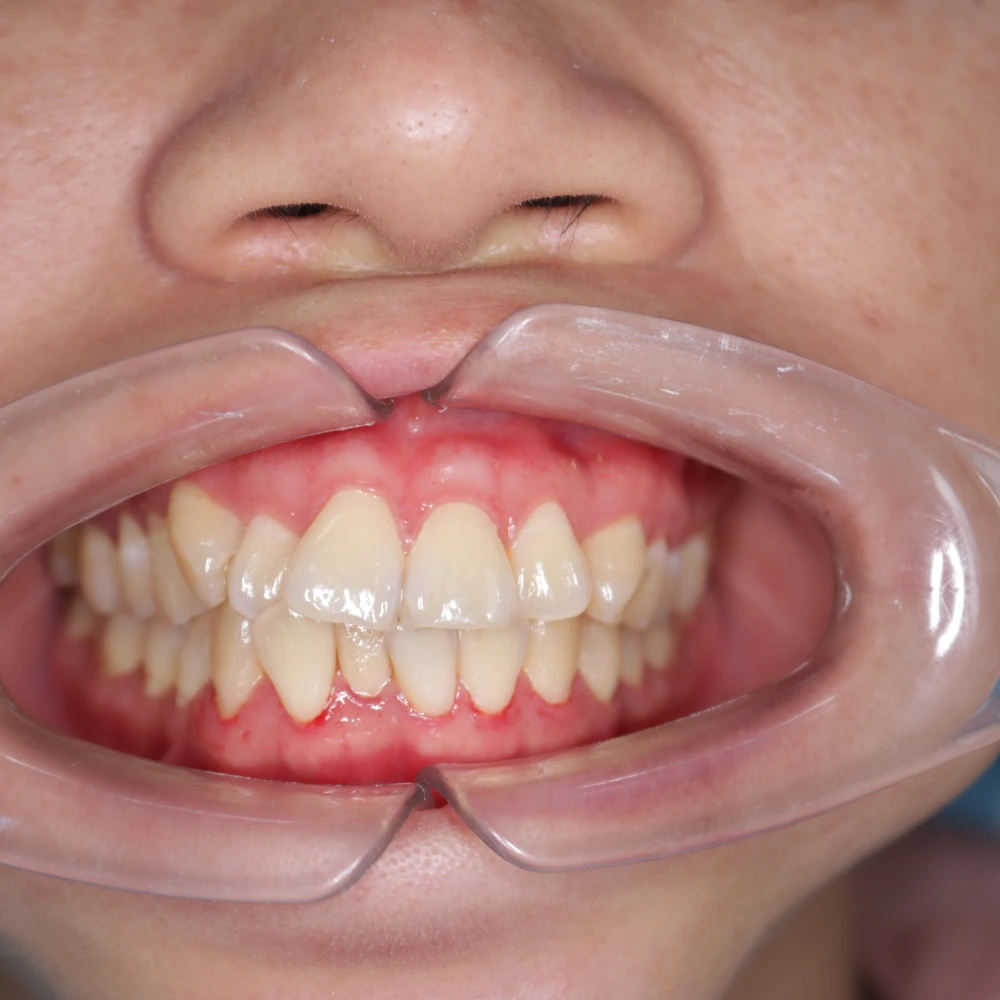 Chị Phạm Oanh Trước Khi Bọc Răng Sứ