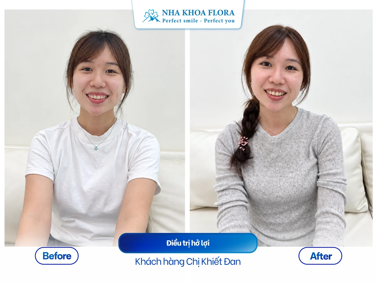 Khách hàng Chị Khiết Đan - Điều trị cười hở lợi
