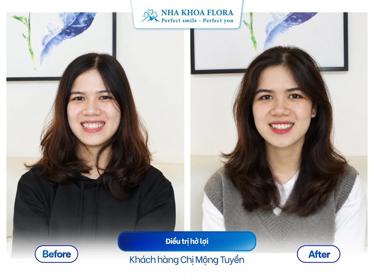 Khách hàng Chị Mộng Tuyền - Điều trị cười hở lợi