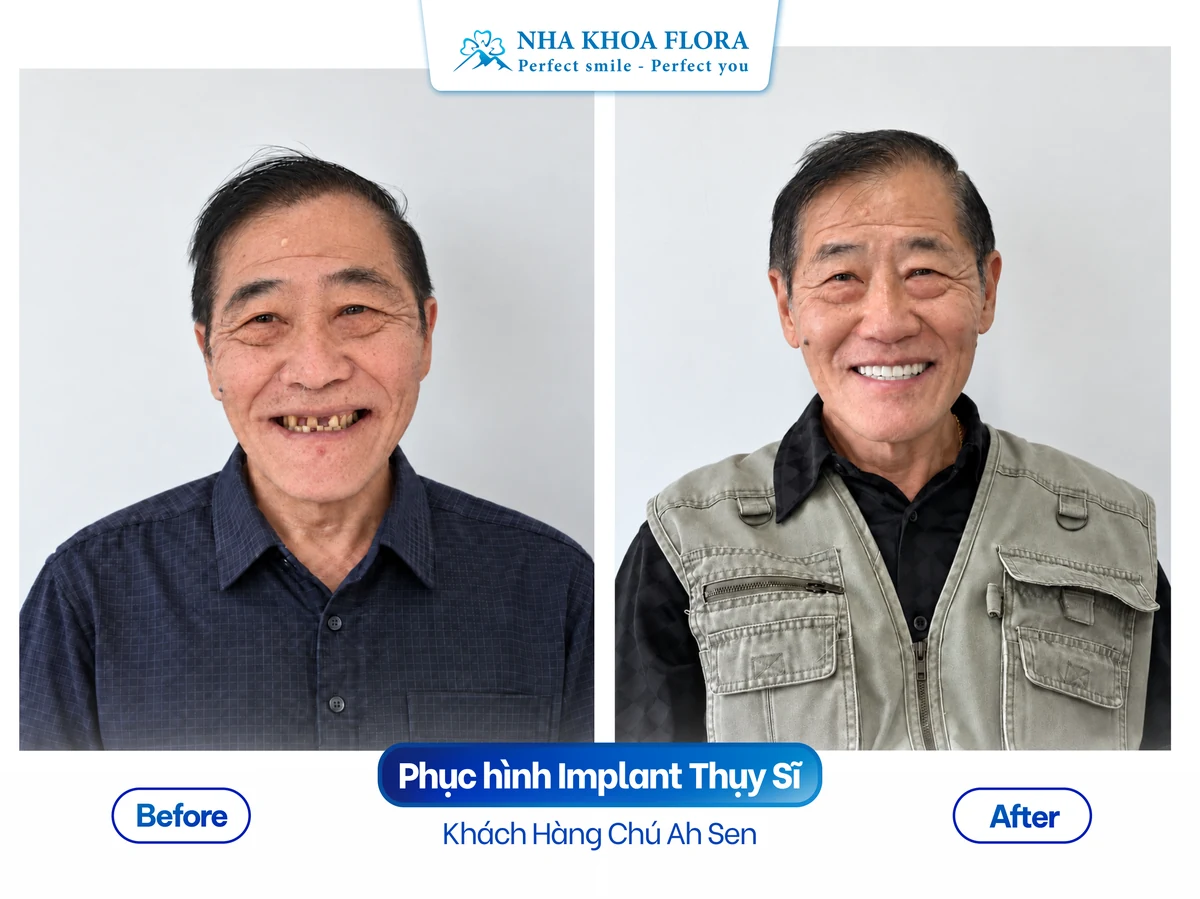 Khách hàng Chú Ah Sen - Phục hình Implant Thụy Sĩ