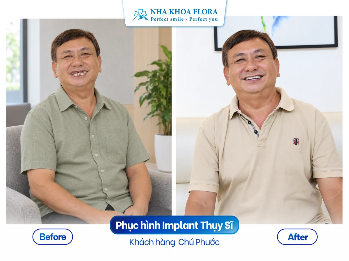 Khách hàng Chú Bá Phước - Phục hình Implant Thụy Sĩ
