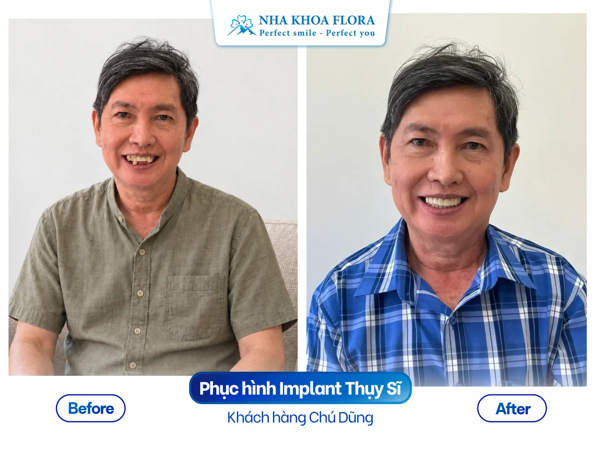 Khách hàng Chú Dũng - Phục hình Implant Thụy Sĩ