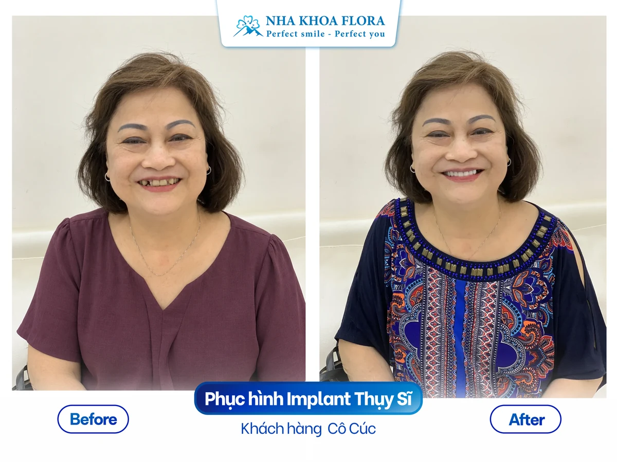 Khách hàng Cô Cúc - Phục hình Implant Thụy Sĩ