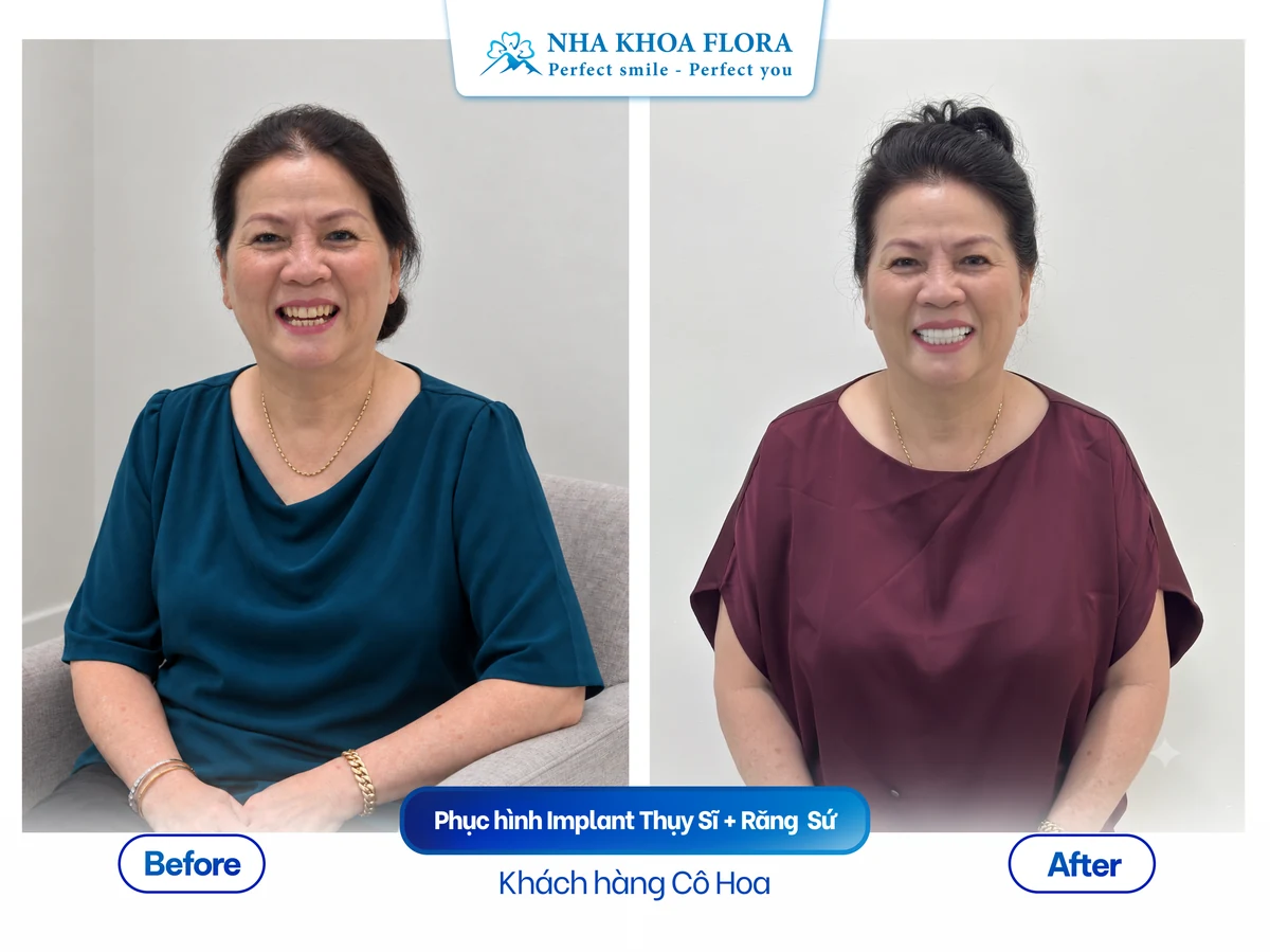 Khách hàng Cô Hoa - Phục hình Implant Thụy Sĩ