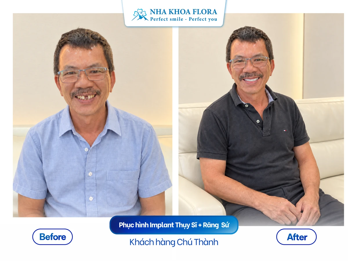 Khách hàng Chú Ngọc Thành - Phục hình All-on-6