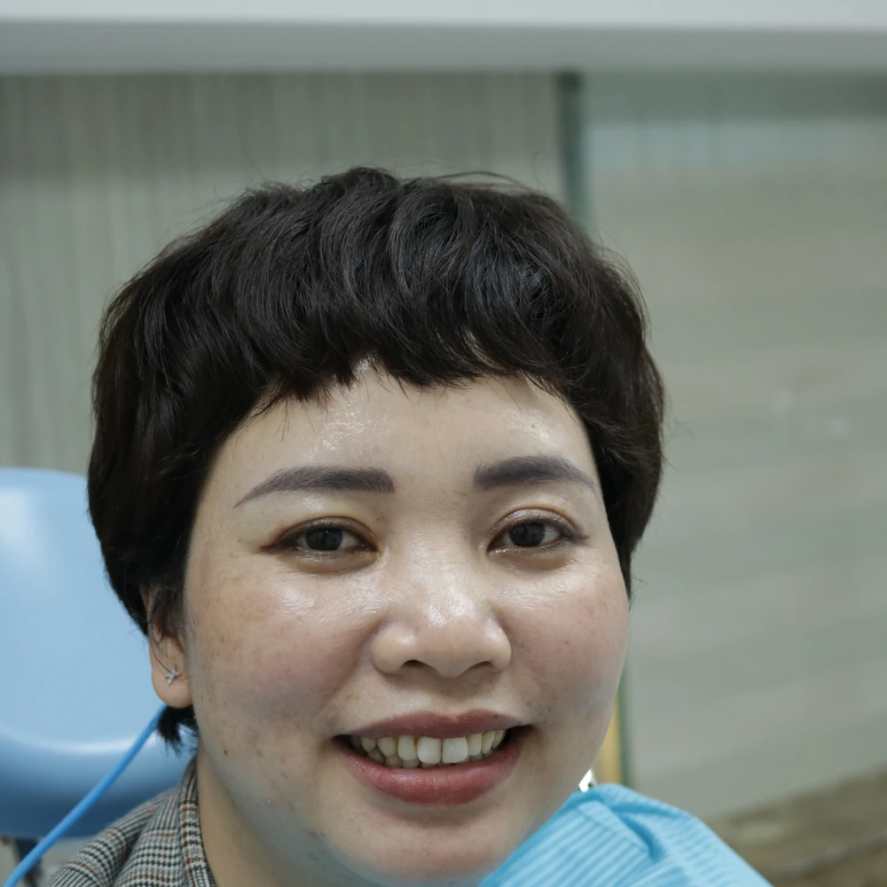 Chị Lê Thị Bích Huyền Trước Khi Dán Sứ Veneer
