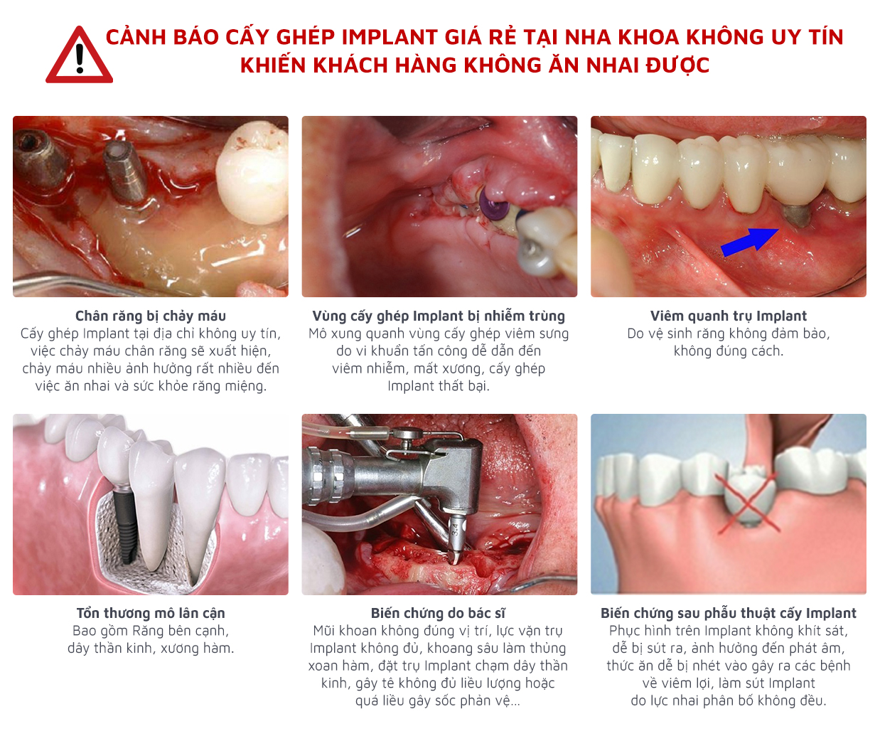 hau qua cua viec trong rang implant gia re hau qua cua viec trong rang implant gia re