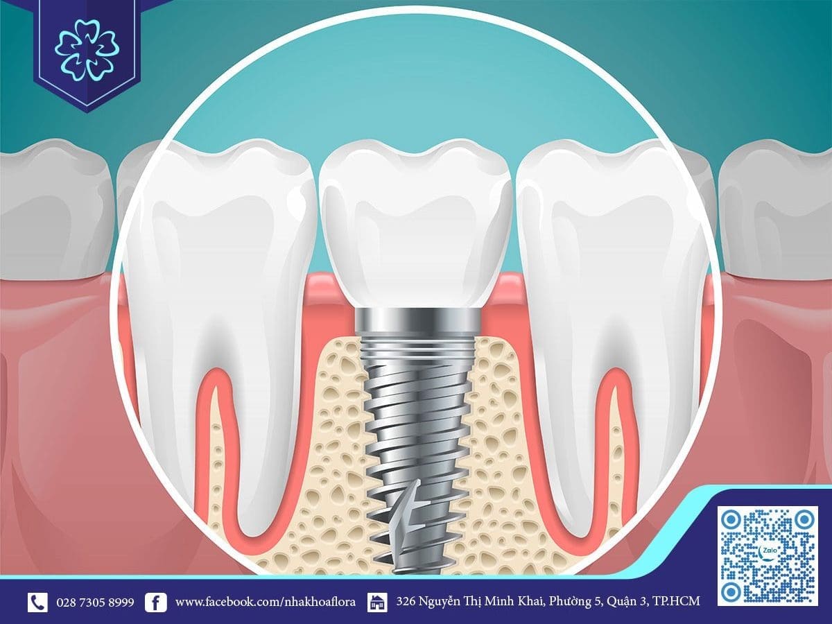 Cấy ghép răng giả Implant là gì?