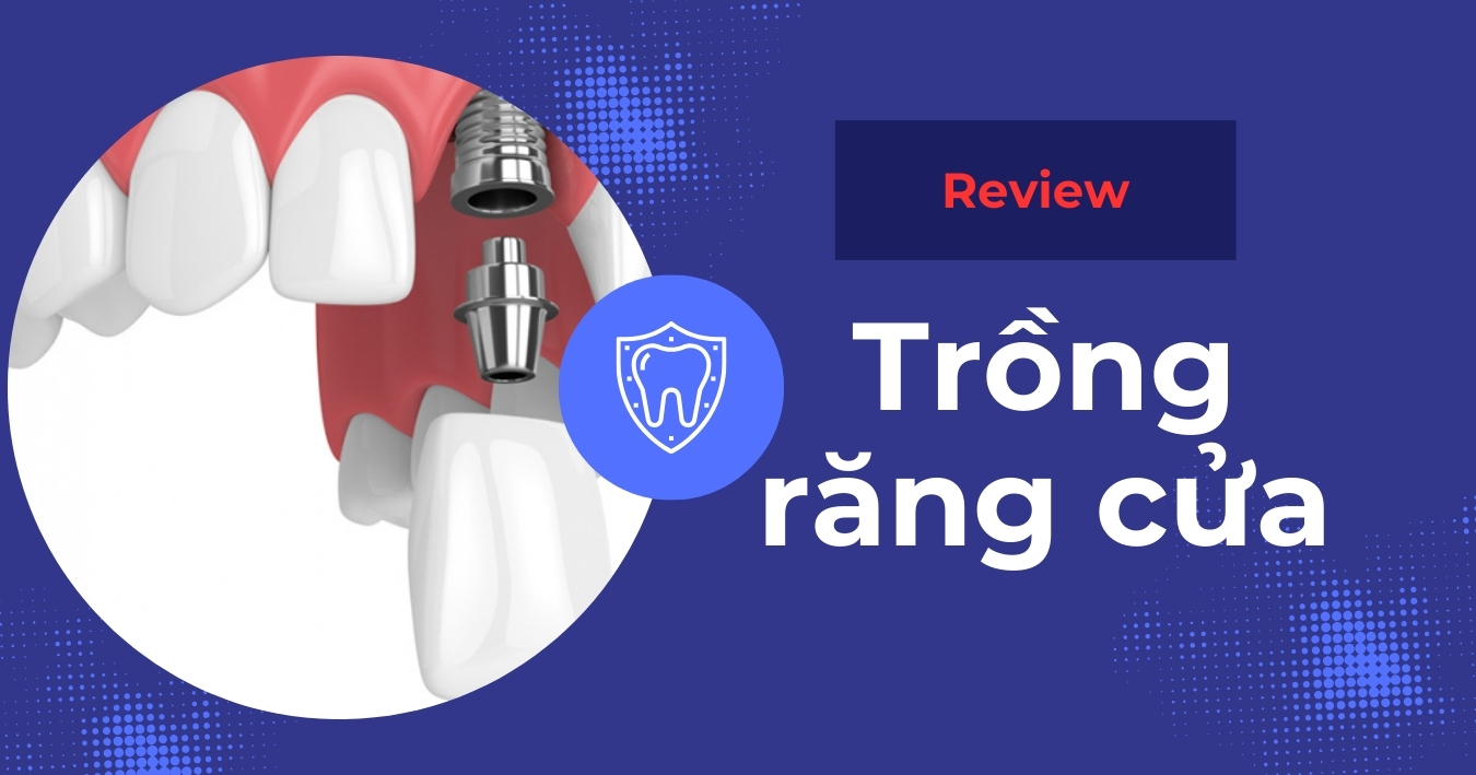 Trồng răng cửa giá bao nhiêu? Phương pháp nào tốt nhất