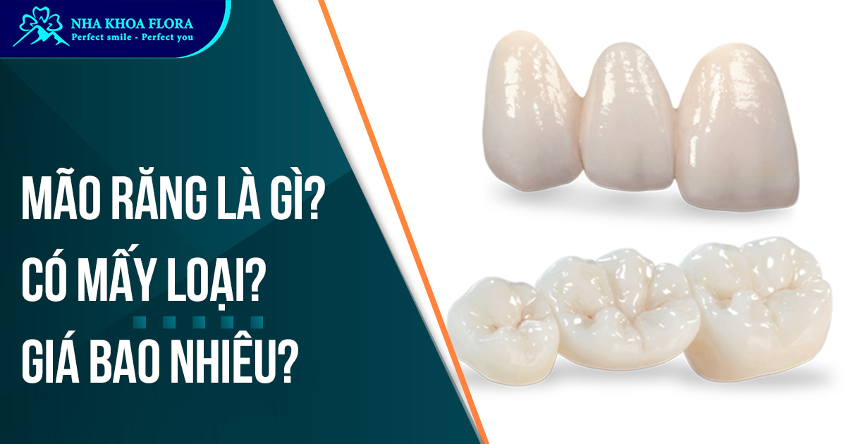 Mão răng sứ là gì? Có mấy loại? Chi phí bao nhiêu tiền?