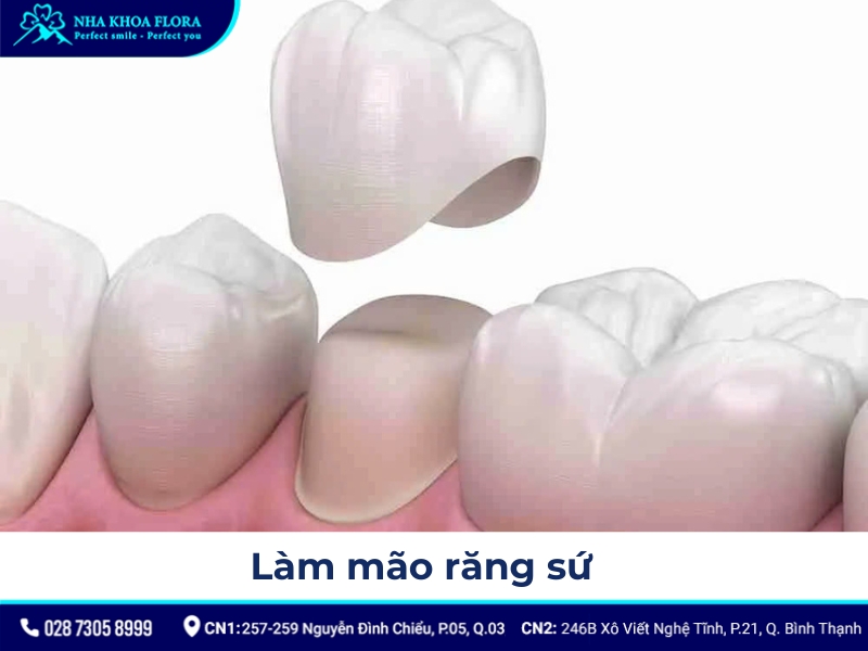 quy trình bọc răng sứ