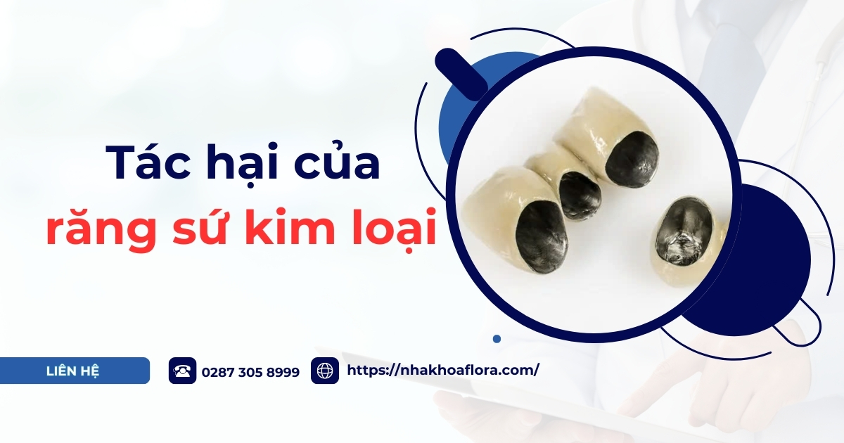 Những tác hại của răng sứ kim loại bạn không nên bỏ qua