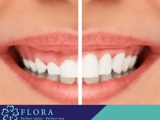 CÓ NÊN ĐIỀU TRỊ CƯỜI HỞ LỢI HAY KHÔNG? 3