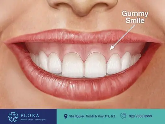 Chữa cười hở lợi bao nhiêu tiền là phù hợp 4