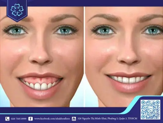 Những phương pháp chữa cười hở lợi ở Việt Nam 6