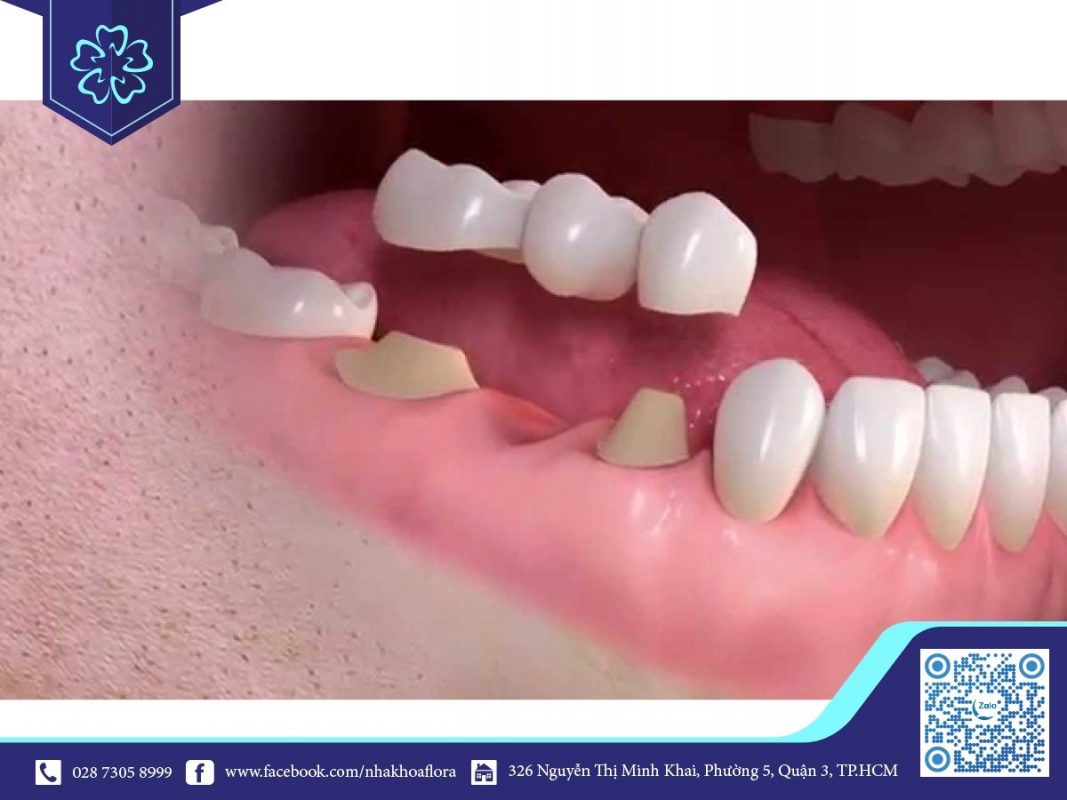 Cầu răng sứ là gì? Cầu răng sứ là gì?