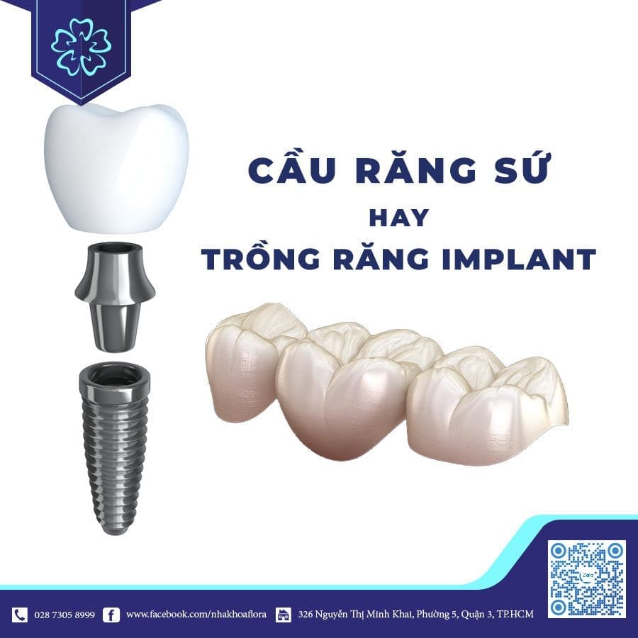 Cầu răng sứ và trồng răng Implant Cầu răng sứ và trồng răng Implant