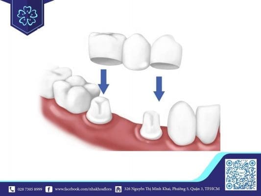 Cầu răng sứ (Hình minh họa)