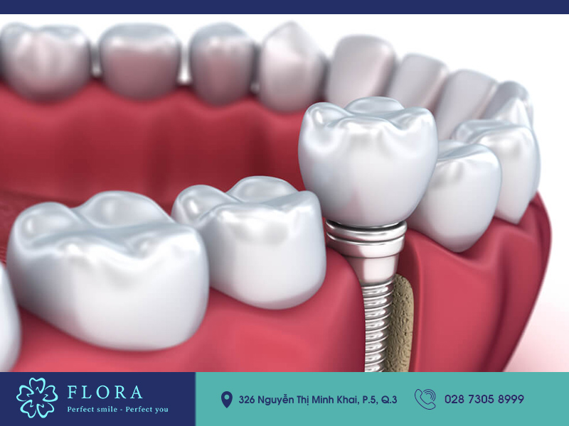 bảng giá cấy ghép implant tại flora trông-rang-implant-bang-gia
