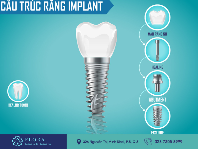 do-tuoi-nao-co-the-trong-rang-implant độ tuổi nào có thể trồng răng implant