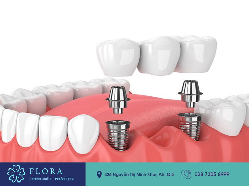 trồng răng implant & trụ Implant cay-ghep-implant-bang-gia
