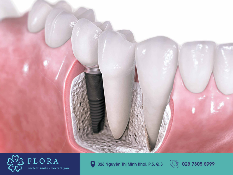 trồng răng cửa bằng phương pháp cấy ghép Implant phuong-phap-trong-rang-implant