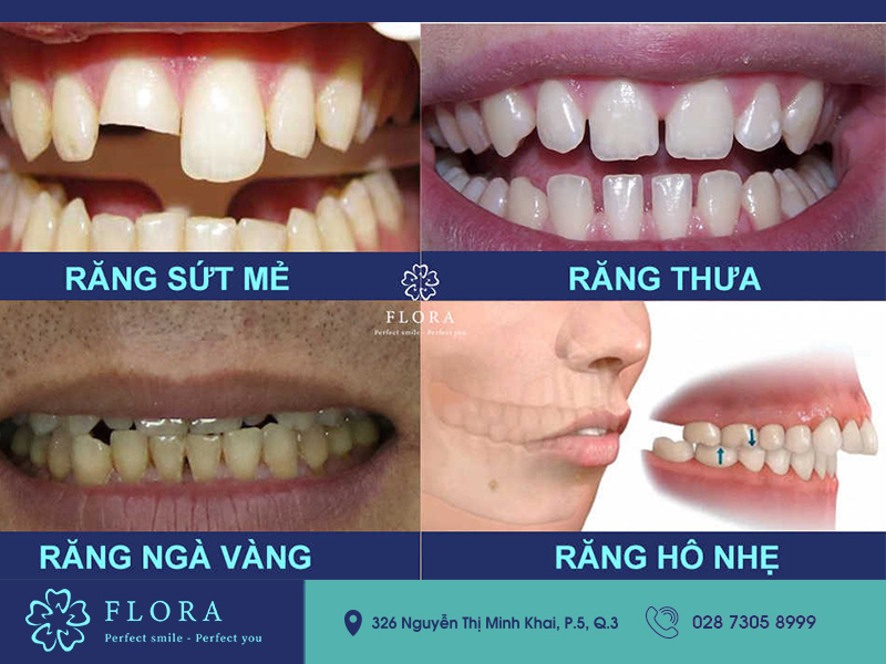 Các trường hợp nên bọc răng sứ các trường hợp bọc răng sứ flora