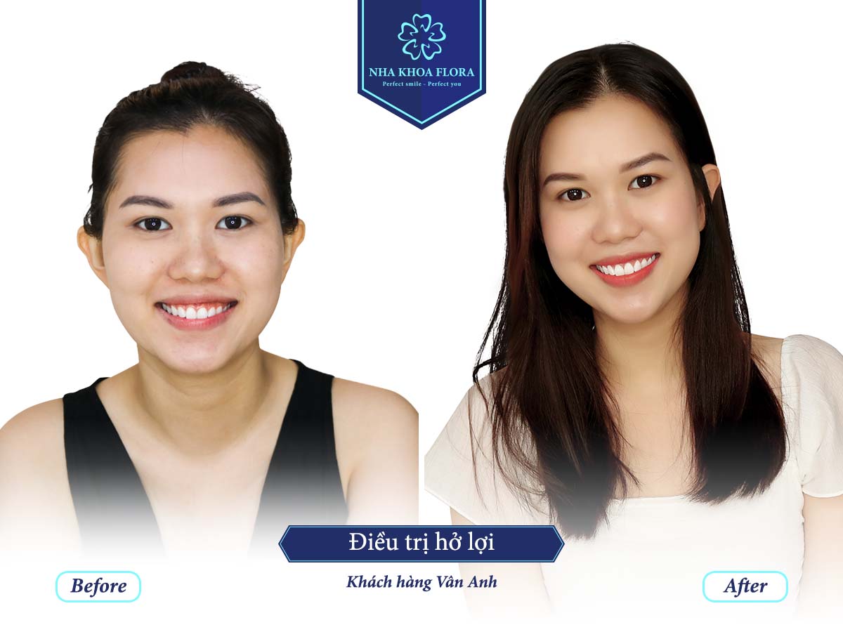 Khách hàng phục hình răng sứ - bác sĩ Nguyễn Đắc Minh phụ trách Khách hàng phục hình răng sứ - bác sĩ Nguyễn Đắc Minh phụ trách