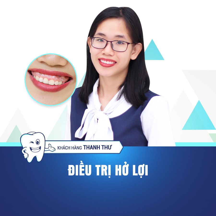 thanh thu điều trị cười hở lợi thanh thu điều trị cười hở lợi