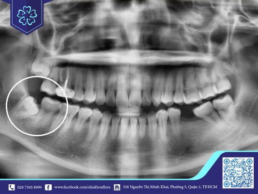 Nhổ răng khôn có nguy hiểm không? Nhổ răng khôn có nguy hiểm không?