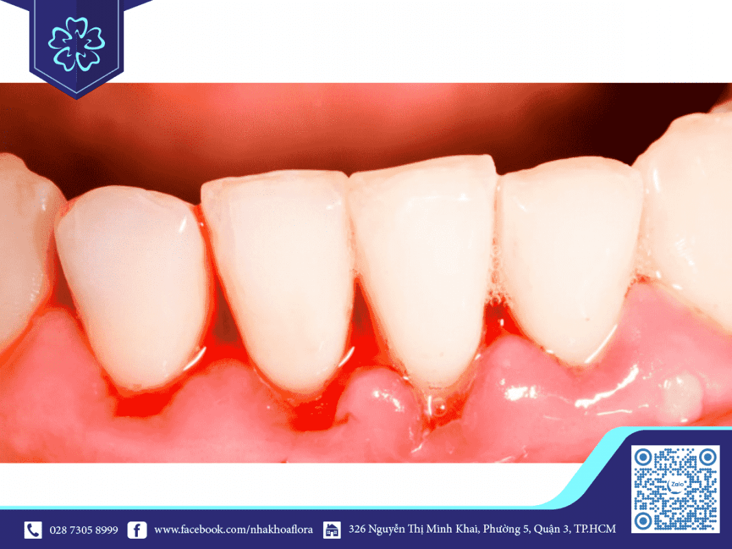 Chảy máu chân răng thường xuyên là bệnh viêm nướu