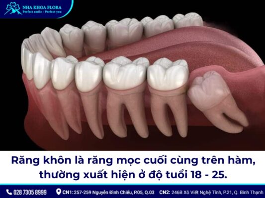 có nên nhổ răng khôn - ảnh 1 có nên nhổ răng khôn - ảnh 1