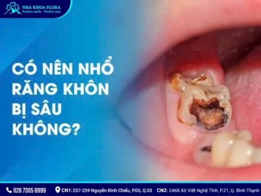 có nên nhổ răng khôn - ảnh 4 có nên nhổ răng khôn - ảnh 4