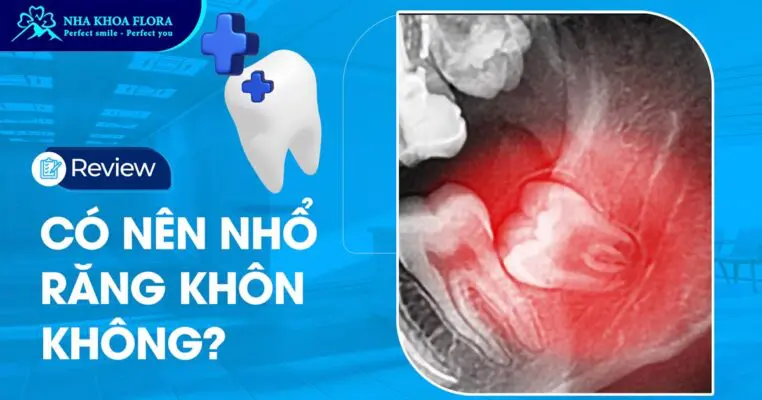 Có nên nhổ răng khôn? Răng số 8 có nên nhổ không Bác sĩ? 8