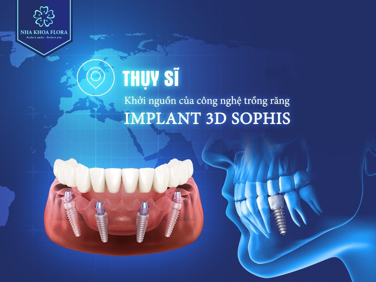 Công nghệ trồng răng implant 3D Sophis tại nha khoa Flora