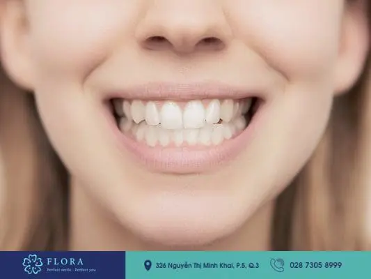 Cười hở lợi có chữa được không? 6