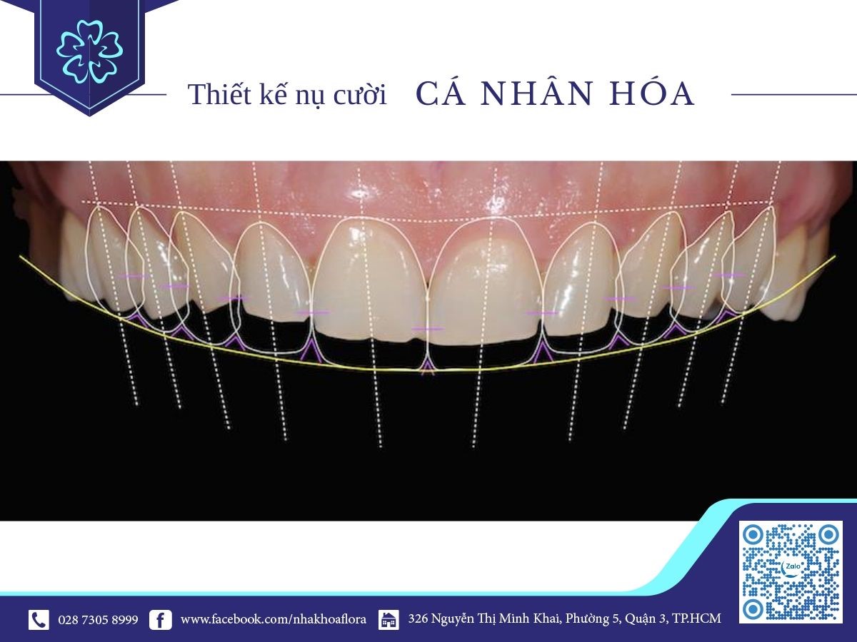 Dán sứ Veneer thiết kế cá nhân hóa Dán sứ Veneer thiết kế cá nhân hóa