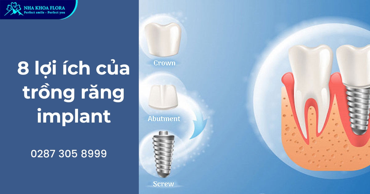 Top 8 lợi ích của trồng răng Implant bạn nên biết