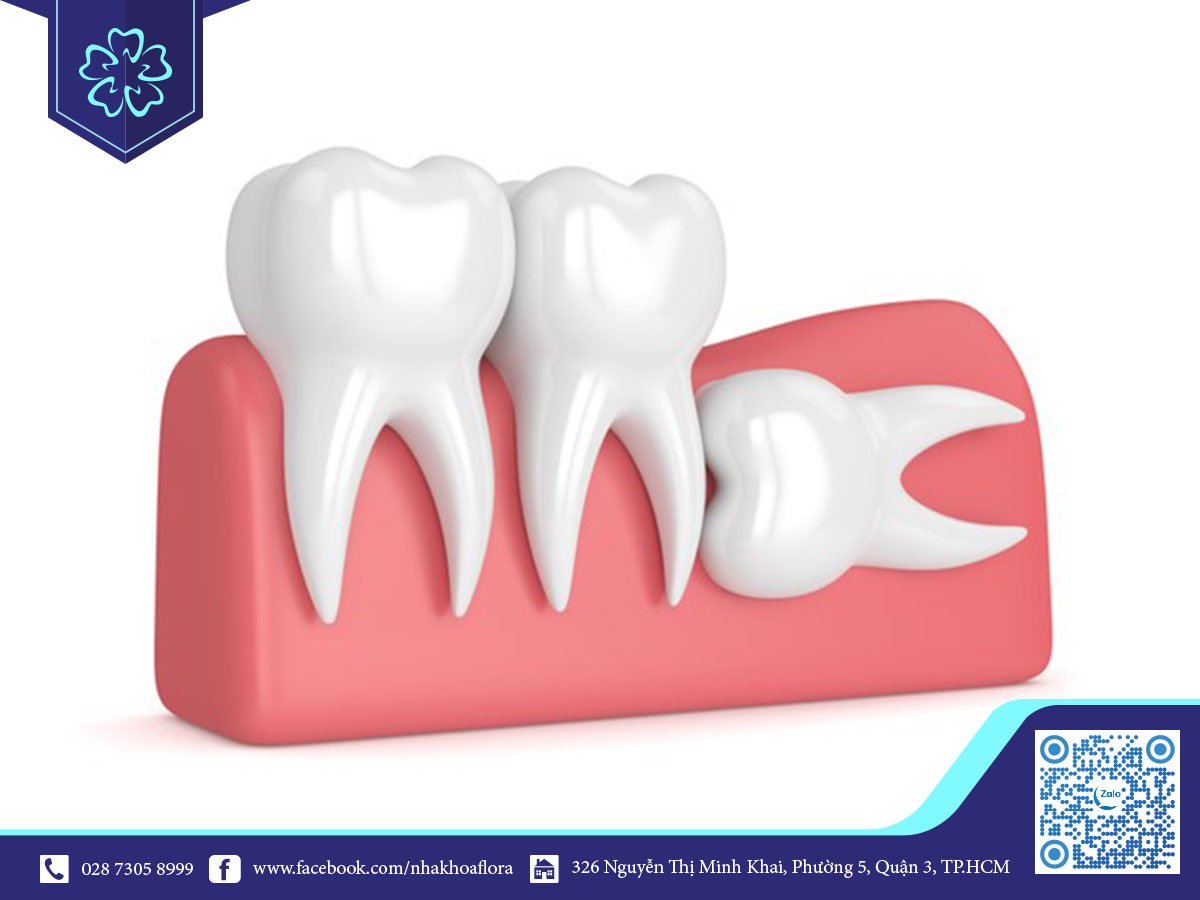 Răng khôn lệch 90 độ Răng khôn lệch 90 độ